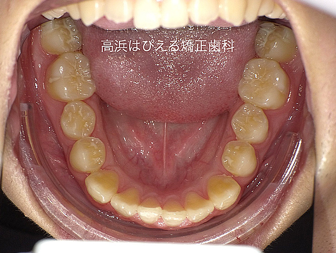 出っ歯（上顎前突）1